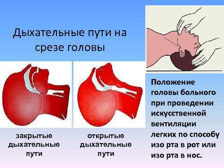Дыхательные пути на срезе головы закрытые дыхательные пути открытые дыхательные пути Положение головы больного