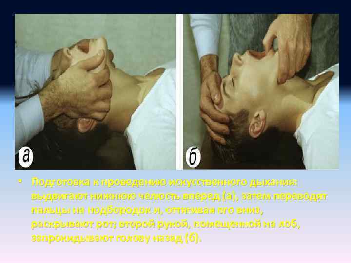  • Подготовка к проведению искусственного дыхания: выдвигают нижнюю челюсть вперед (а), затем переводят