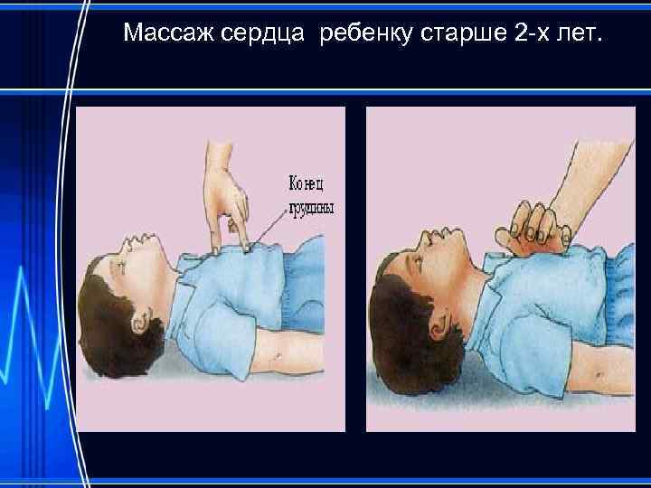 Массаж сердца ребенку старше 2 -х лет. 