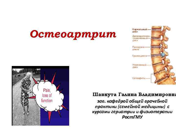 Остеоартрит Шавкута Галина Владимировна зав. кафедрой общей врачебной практики (семейной медицины) с курсами гериатрии