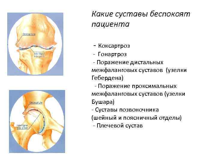 Коксартроз и гонартроз