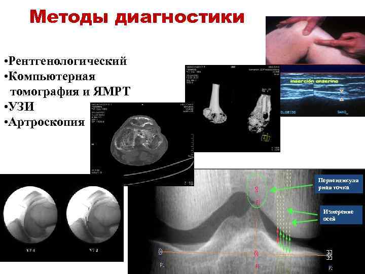 Методы диагностики • Рентгенологический • Компьютерная томография и ЯМРТ • УЗИ • Артроскопия Перпендикуля