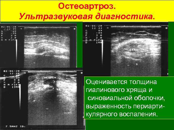 Остеоартроз. Ультразвуковая диагностика. Оценивается толщина гиалинового хряща и синовиальной оболочки, выраженность периартикулярного воспаления. 