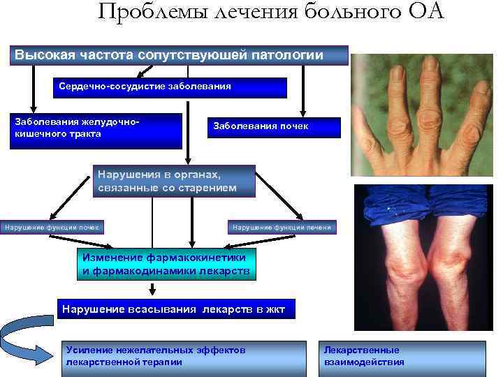 Проблемы лечения больного ОА Высокая частота сопутствуюшей патологии Сердечно-сосудистие заболевания Заболевания желудочнокишечного тракта Заболевания