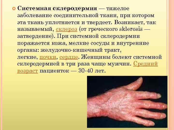  Системная склеродермия — тяжелое заболевание соединительной ткани, при котором эта ткань уплотняется и