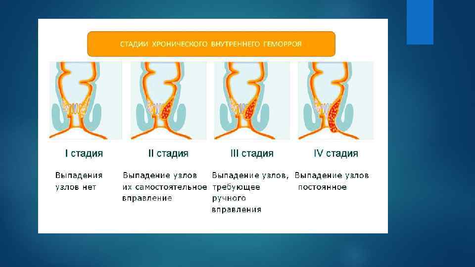 А г 2 стадии. Выпадение узлов геморроя 2 степени. Хронический геморрой классификация. Степень геморроя выпадения узлов. Выпадение внутренних геморроидальных узлов.