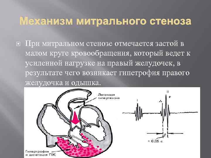 Митральный аортальный стеноз. Механизм развития недостаточности сердца при митральном стенозе. Механизмы компенсации при митральном стенозе. Изменения сердца при митральном стенозе. При стенозе митрального клапана.