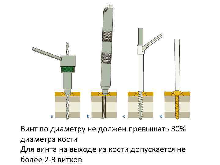 Накостный остеосинтез Винт по диаметру не должен превышать 30% диаметра кости Для винта на