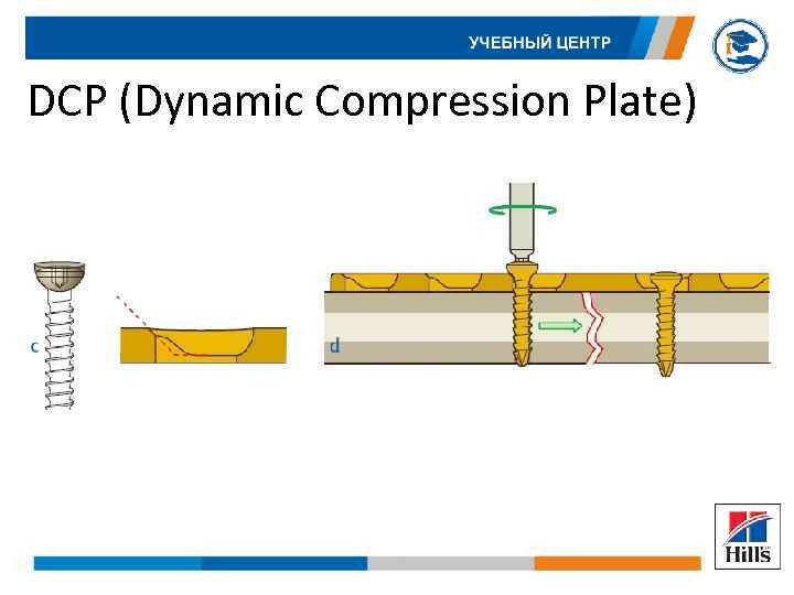 DCP (Dynamic Compression Plate) 