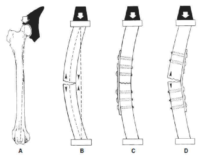 LCP (Locking compression plate) блокирующая компрессионная пластина 