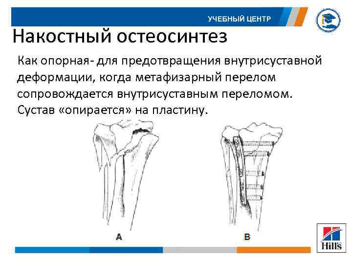 Накостный остеосинтез Как опорная- для предотвращения внутрисуставной деформации, когда метафизарный перелом сопровождается внутрисуставным переломом.