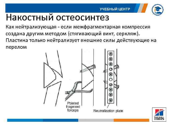 Накостный остеосинтез Как нейтрализующая - если межфрагментарная компрессия создана другим методом (стягивающий винт, серкляж).