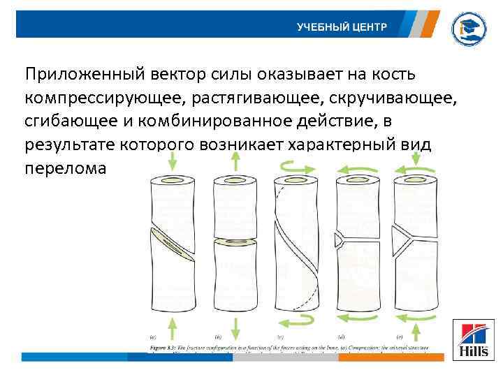 Приложенный вектор силы оказывает на кость компрессирующее, растягивающее, скручивающее, сгибающее и комбинированное действие, в