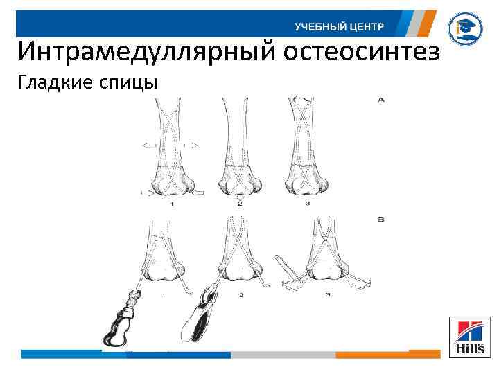 Интрамедуллярный остеосинтез Гладкие спицы 