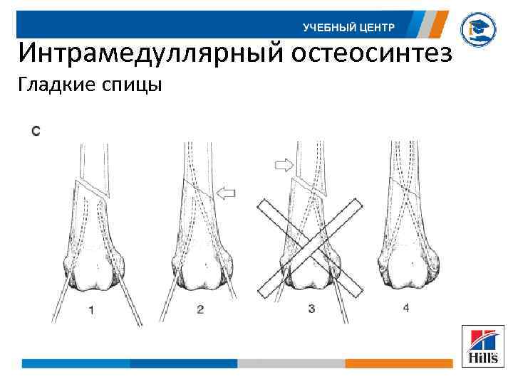 Интрамедуллярный остеосинтез Гладкие спицы 