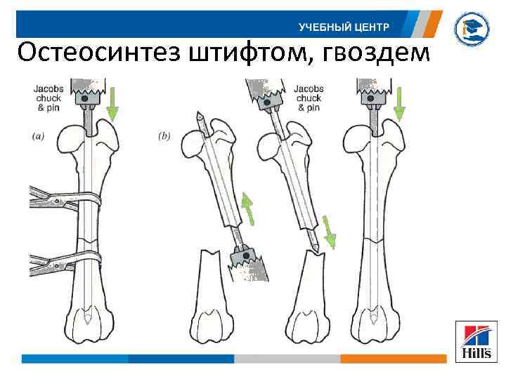 Остеосинтез штифтом, гвоздем 