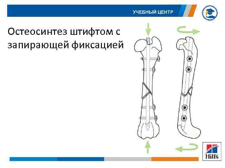 Остеосинтез штифтом с запирающей фиксацией 