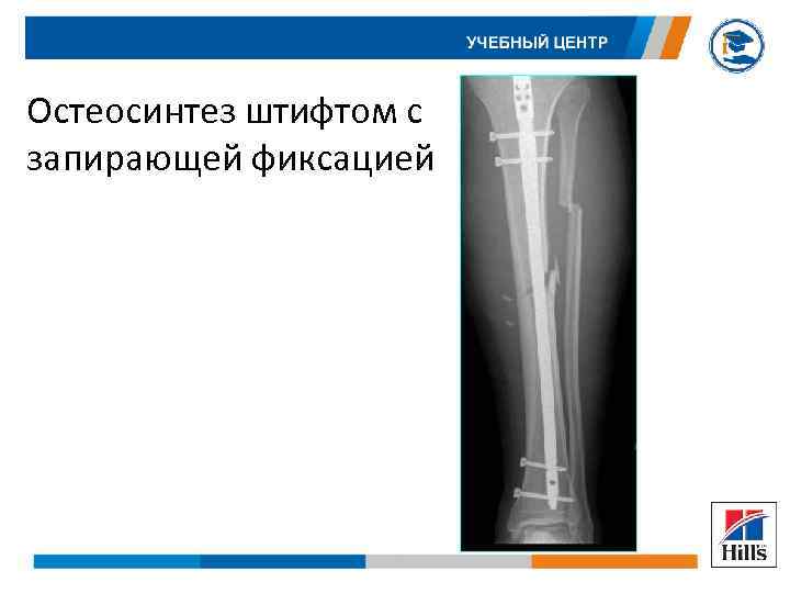 Остеосинтез штифтом с запирающей фиксацией 