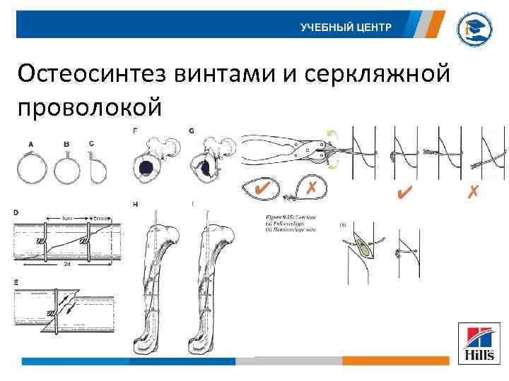 Остеосинтез винтами и серкляжной проволокой 