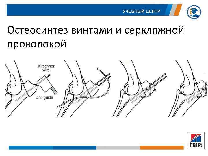 Остеосинтез винтами и серкляжной проволокой 