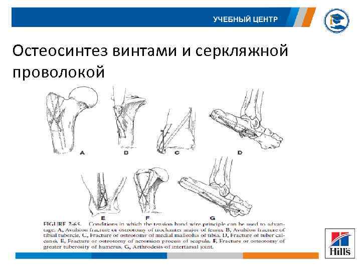 Операция перелом локтевого отростка. Серкляжный остеосинтез это. Остеосинтез локтевого сустава по методу Вебера. Серкляжная проволока для остеосинтеза. Проволочный остеосинтез.