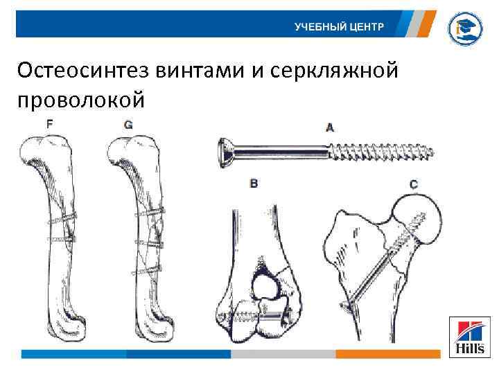 Остеосинтез винтами и серкляжной проволокой 