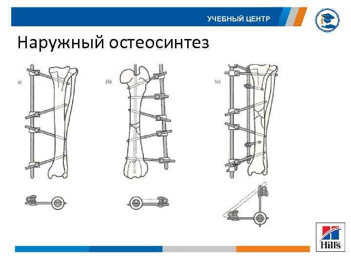 Наружный остеосинтез 