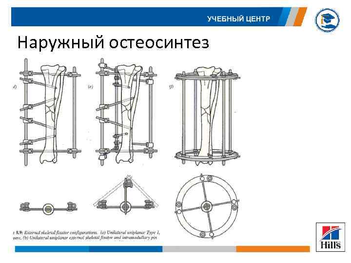 Наружный остеосинтез 