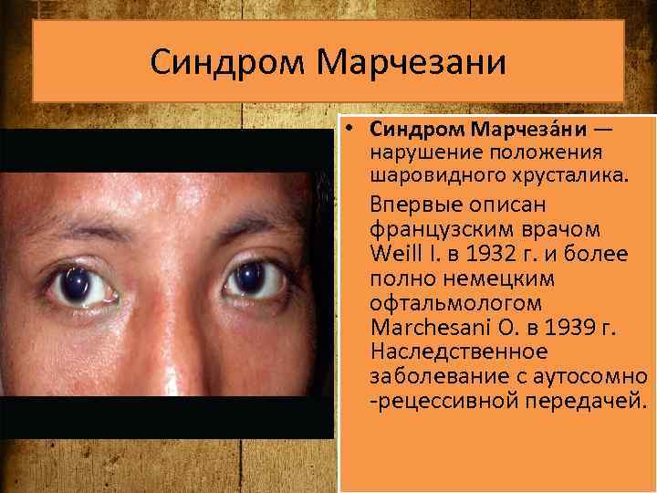 Синдром Марчезани • Синдром Марчеза ни — нарушение положения шаровидного хрусталика. Впервые описан французским