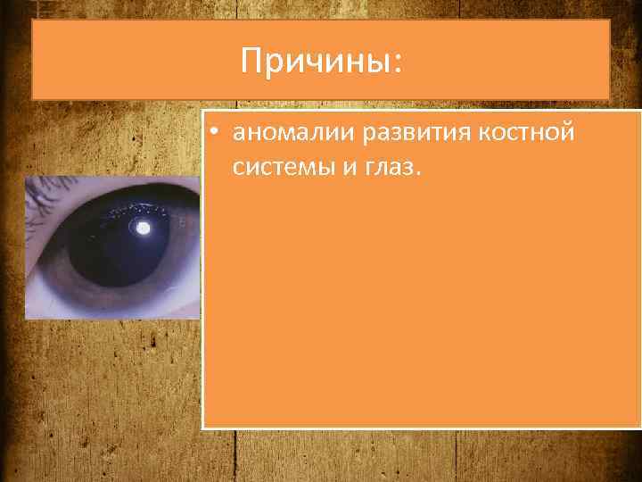 Причины: • аномалии развития костной системы и глаз. 