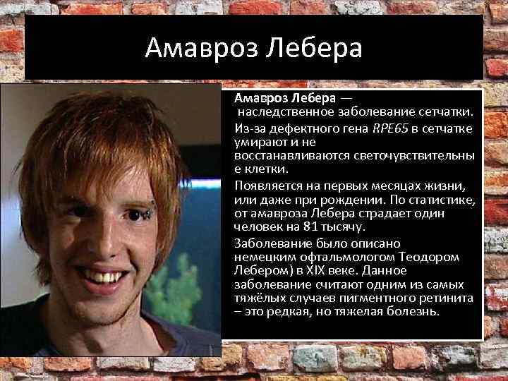 Амавроз Лебера • Амавроз Лебера — наследственное заболевание сетчатки. • Из-за дефектного гена RPE