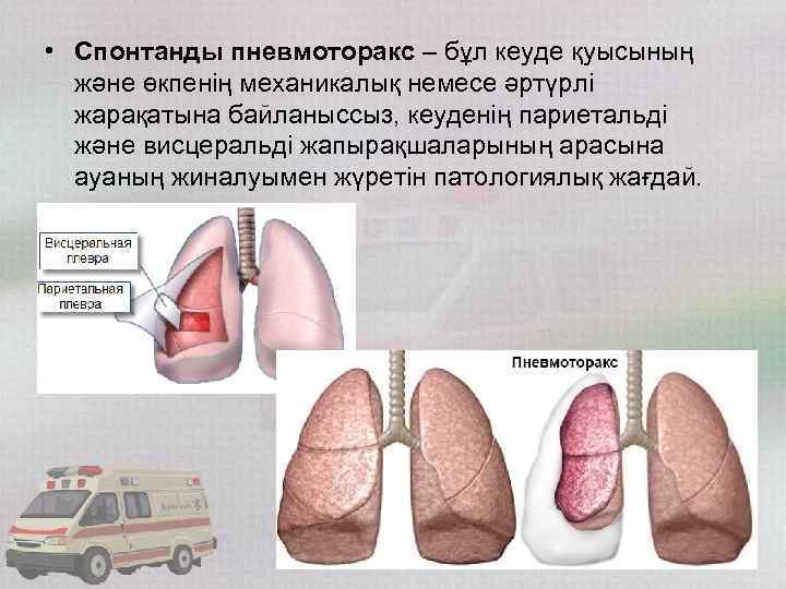  • Спонтанды пневмоторакс – бұл кеуде қуысының және өкпенің механикалық немесе әртүрлі жарақатына