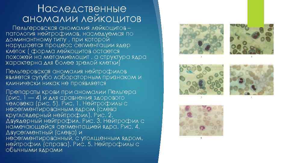 Наследственные аномалии лейкоцитов Пельгеровская аномалия лейкоцитов – патология нейтрофилов, наследуемая по доминантному типу ,