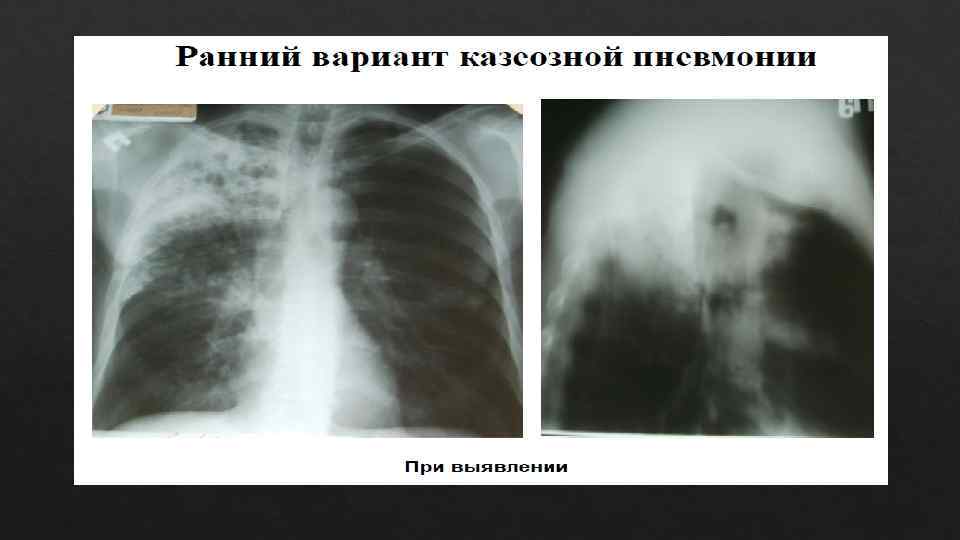 Казеозная пневмония презентация