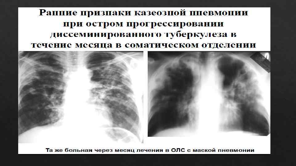 Клиническая картина казеозной пневмонии обычно характеризуется