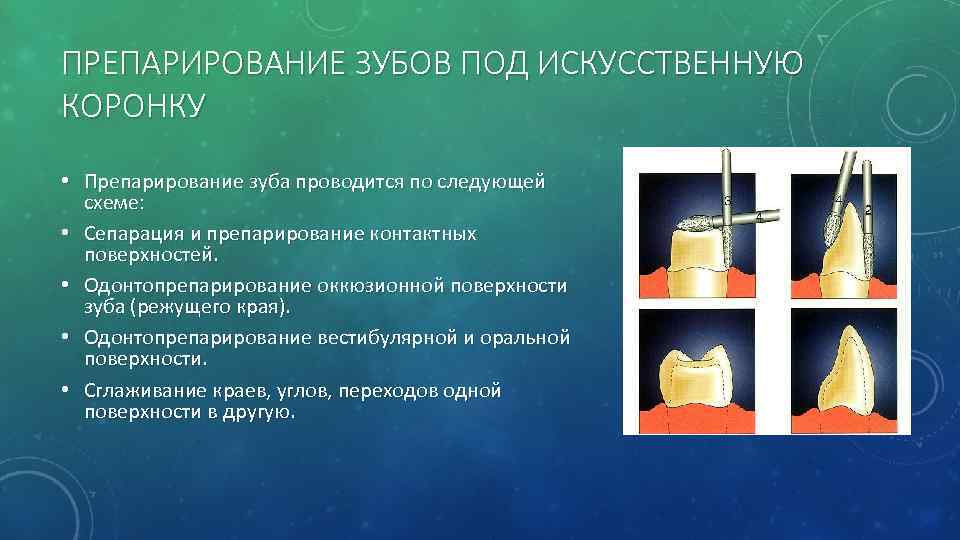 ПРЕПАРИРОВАНИЕ ЗУБОВ ПОД ИСКУССТВЕННУЮ КОРОНКУ • Препарирование зуба проводится по следующей схеме: • Сепарация