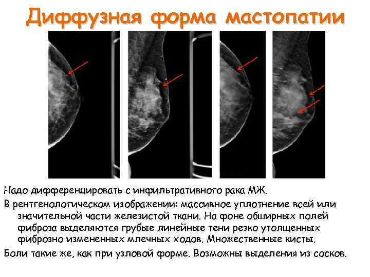 Что означает фиброзное изменение. Диффузная фиброзно-кистозная мастопатия. Кистозная мастопатия маммография. Фиброзная мастопатия маммограмма. Диффузионная фиброзно-кистозная мастопатия.