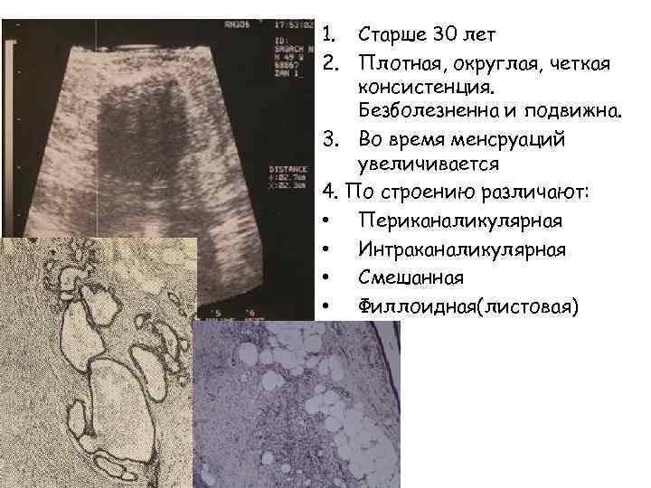 1. Старше 30 лет 2. Плотная, округлая, четкая консистенция. Безболезненна и подвижна. 3. Во