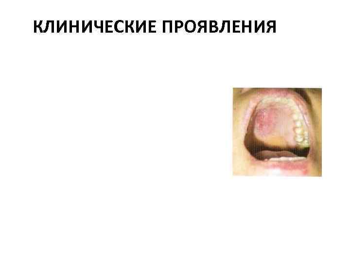 КЛИНИЧЕСКИЕ ПРОЯВЛЕНИЯ 