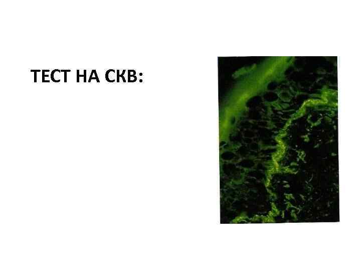 ТЕСТ НА СКВ: 