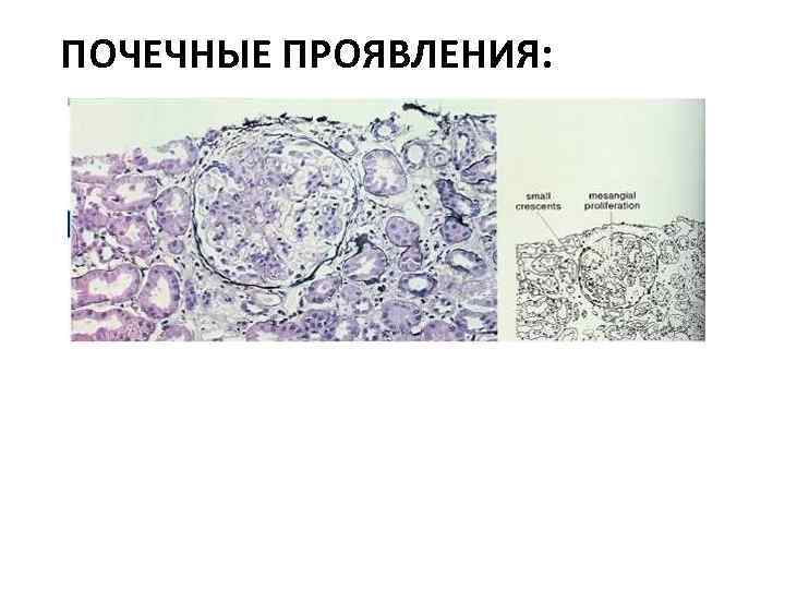 ПОЧЕЧНЫЕ ПРОЯВЛЕНИЯ: 