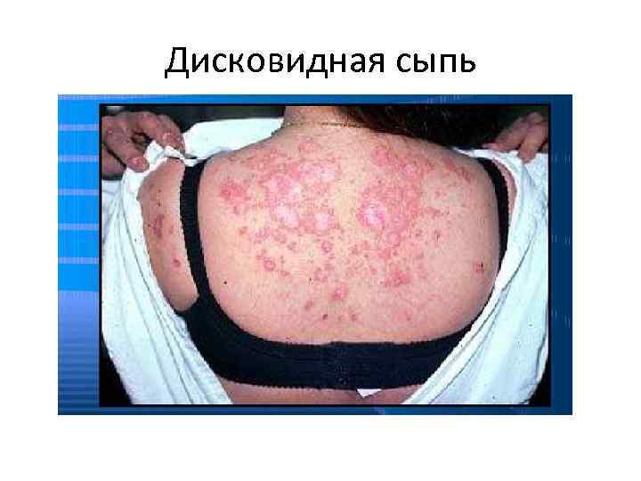 Дисковидная сыпь 