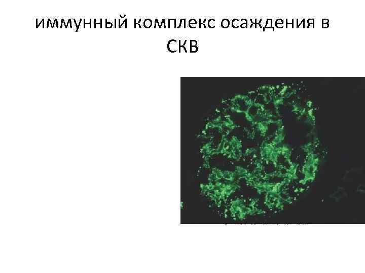 иммунный комплекс осаждения в СКВ 