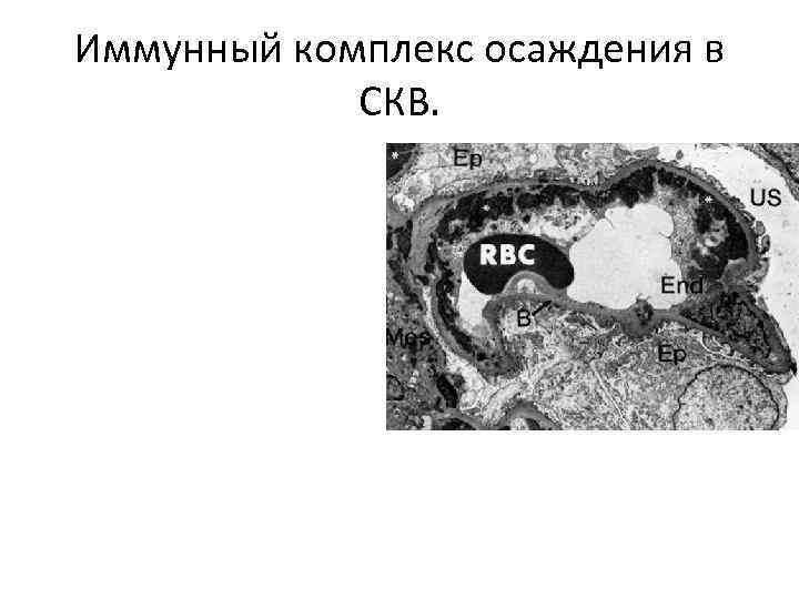 Иммунный комплекс осаждения в СКВ. 