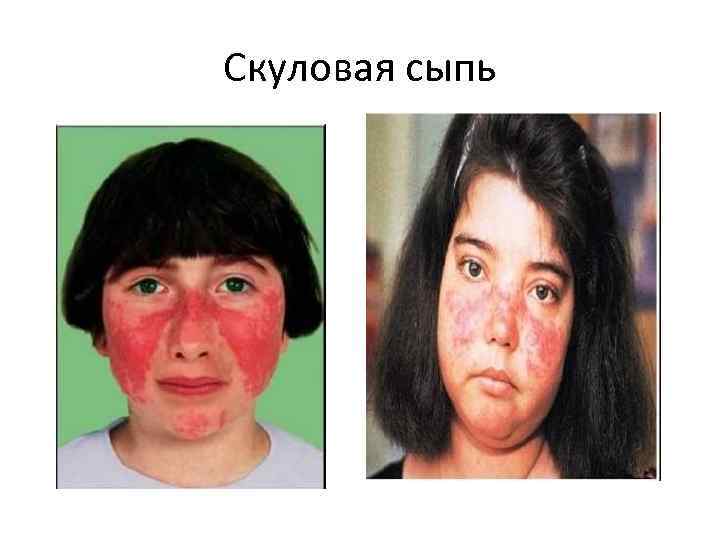 Скуловая сыпь 