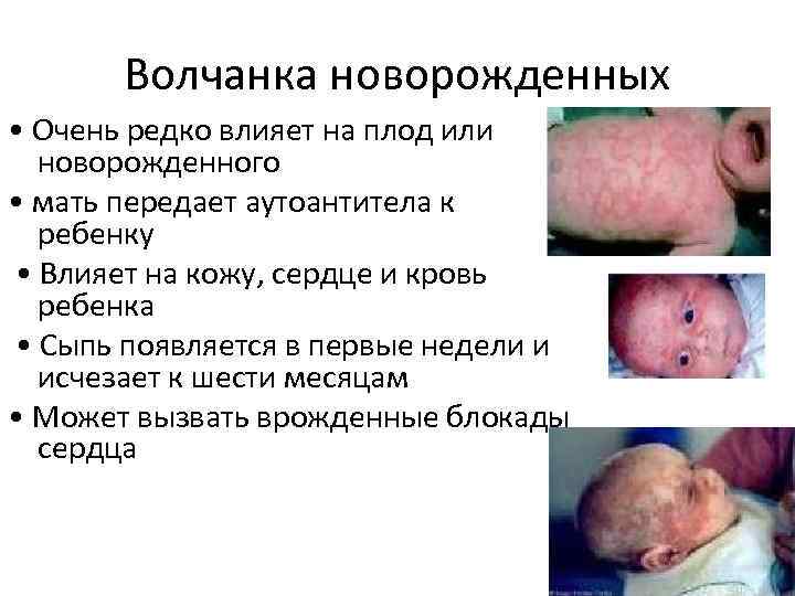 Волчанка новорожденных • Очень редко влияет на плод или новорожденного • мать передает аутоантитела