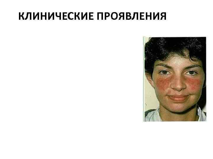 КЛИНИЧЕСКИЕ ПРОЯВЛЕНИЯ 