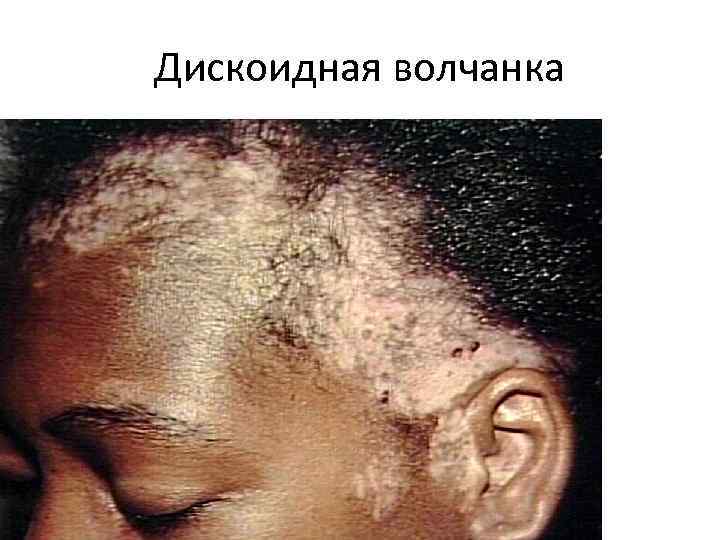 Дискоидная волчанка 