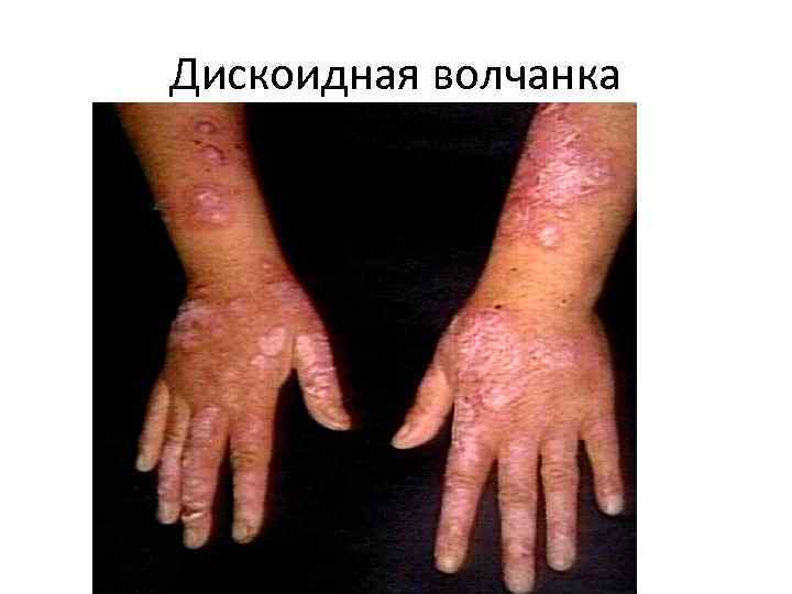 Дискоидная волчанка 