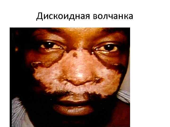 Дискоидная волчанка 